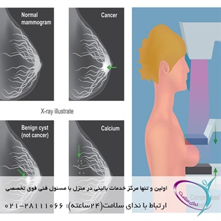 انجام خدمات ماموگرافی در منزل